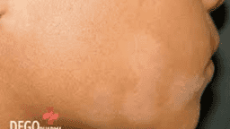 Các câu hỏi thường gặp trong bệnh vảy phấn trắng: bệnh da giảm sắc tố thường gặp về mùa đông