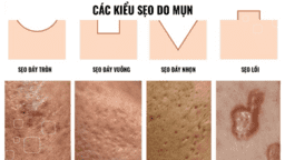 HƯỚNG DẪN CHĂM SÓC VÀ PHÒNG NGỪA SẸO SAU MỤN TRỨNG CÁ