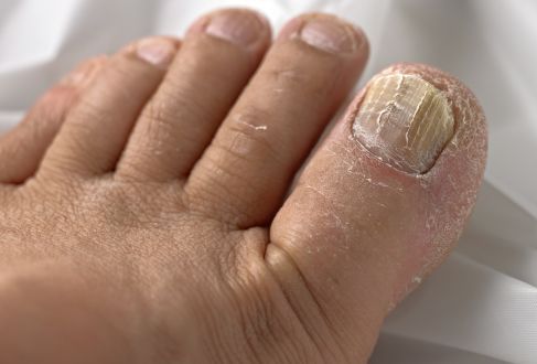 Một số bệnh thường gặp ở móng chân
