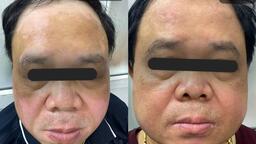 HIỆU QUẢ ĐIỀU TRỊ BẠCH BIẾN BẰNG UVB DẢI HẸP TẠI TRUNG TÂM DA LIỄU