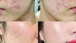 MỤN TRỨNG CÁ VÀ BIẾN CHỨNG