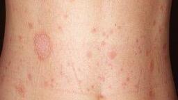VẢY PHẤN HỒNG (PITYRIASIS ROSEA) – NHỮNG ĐIỀU CẦN BIẾT