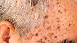 DÀY SỪNG DA DẦU (Dày sừng tiết bã)