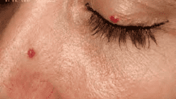 U MÁU ANH ĐÀO & MỘT SỐ CÂU HỎI THUỜNG GẶP