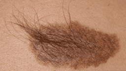 BECKER'S NEVUS